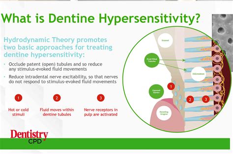 Dentin Hypersensitivity from Bleaching Inside Dentistry