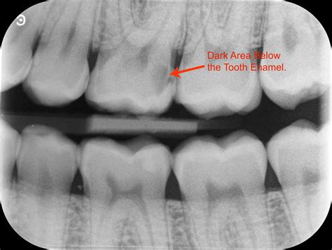 Dentist has just told me there is a shadow on a dental x ray…