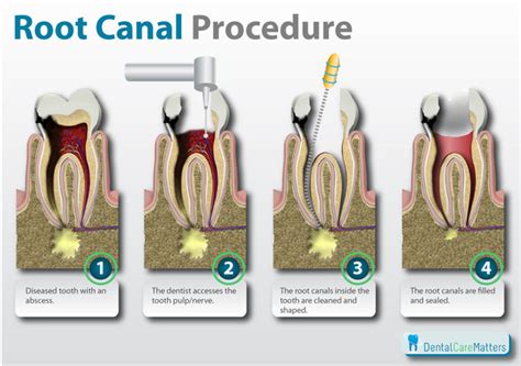 Dentistry explained patient guide to root canal therapy. - Worin liegt die grösse des wilhelm münzenberg?.