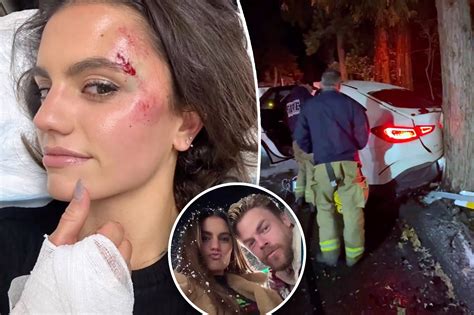 Derek hough car accident. Hough has not commented on a possible cause of the burst brain vessel, but a year ago Erbert was injured in a car accident with Hough in the San Bernardino Mountains. The crash left her with ... 