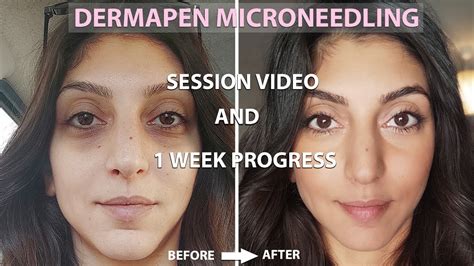 Dermapen before and after.  Dermapen&reg; Cartridges + Protective Sleeves (15 Each) $ 620. 00 Add ...