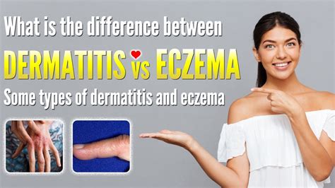 Dermatitis herpetiformis vs eczema Similarities and differences