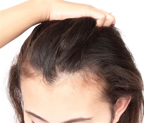 Dermatologist Can Help Treat Your Hair Loss Washington DC