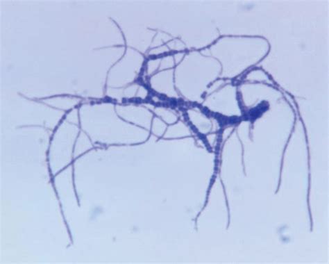 Dermatophilus congolensis human infection - PubMed