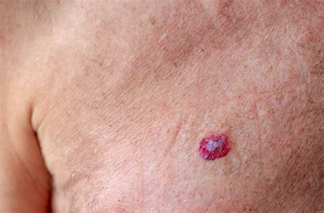 Dermatopolymyosite paranéoplasique révélatrice d’un carcinome …