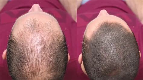 Dermmatch. DermMatch is a product that claims to make thin hair look thicker and more natural. Read how people with thin hair, hair loss, or gray hair use DermMatch to regain their … 
