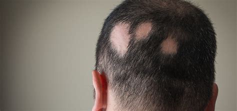Dermovate alopecia areata