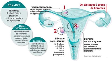 Des fibromyomes gangrenés non pediculés de l'utérus et de leur traitement. - Legal guide to aia documents 2003 cumulative supplement.