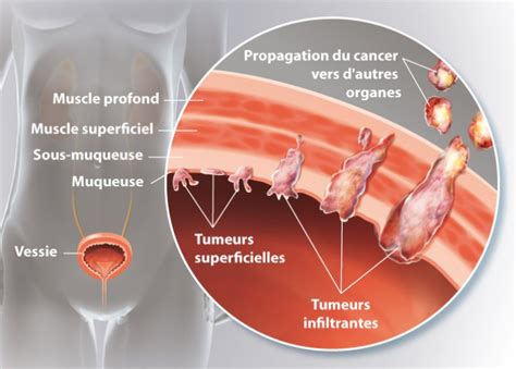 Des tumeurs polypoïdes du méat urinaire chez la femme. - Iso or iec 200002011 a pocket guide.