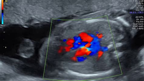 Detaylı ultrasonda kalpte delik
