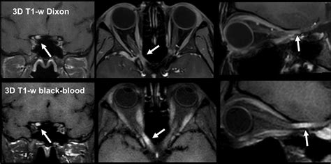 Detection of Acute Optic Neuritis using Contrast-Enhanced 3 …