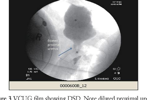 Detrusor-Sphincter Dyssynergia - ScienceDirect