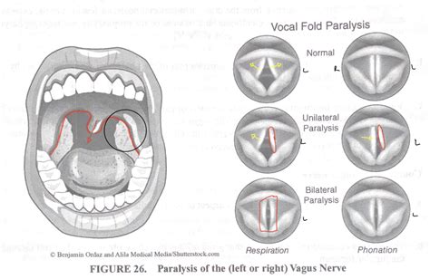 Deviating uvula. 