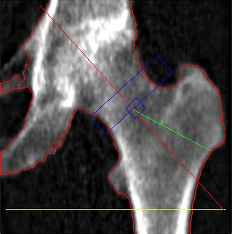 Dexa Scan Sydney and Randwick BMD Dexa Xray - Spectrum …