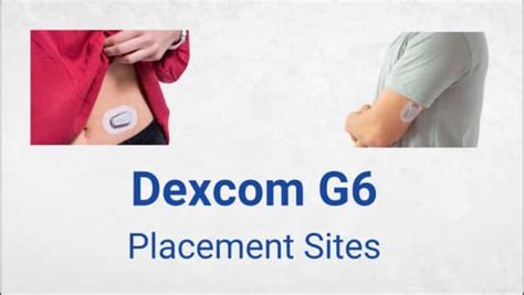 Dexcom G6 accuracy when inserted in upper thigh