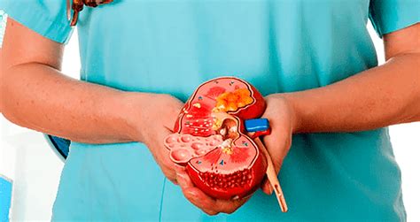 Diálisis y trasplantes de riñón la guía a su alcance en la punta de sus dedos. - Mercatile law grade 12 study guide.