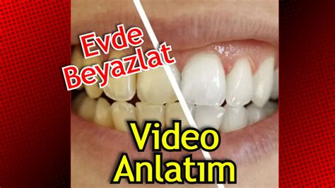 Diş Yüzeyindeki Lekeler Nasıl Geçer DonanımHaber Forum. 