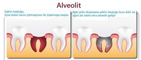 Diş alveolit nedir