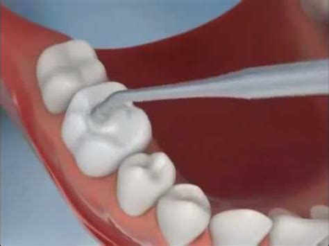 Diş dolgusu nasıl yapılır video izle
