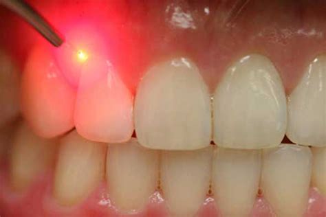 Diş eti çekilmesinde lazer tedavisi