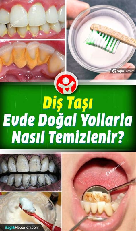 Diş taşı doğal tedavi
