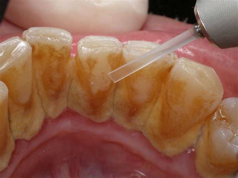 Diş taşı temizliği nerede yapılır