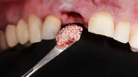 Dişe kemik tozu uygulaması ne kadar sürer