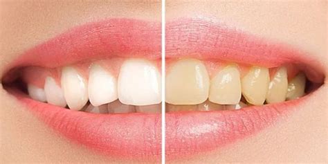 Dişler en çabuk nasıl beyazlar