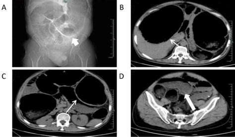 Diabetes, Megacolon and an update on Leonardo