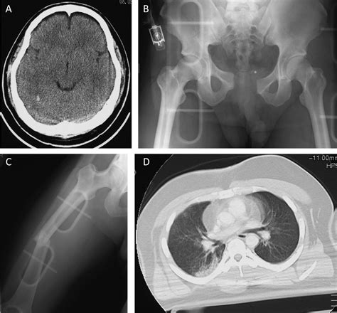 Diabetes Insipidus after Traumatic Brain Injury - PubMed