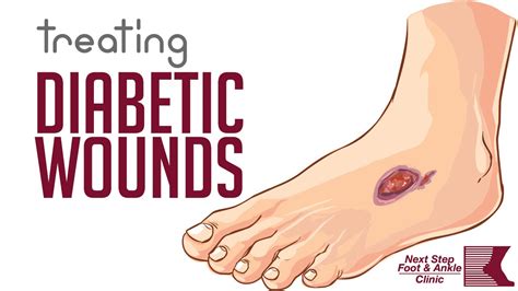 Diabetic Leg Wounds - Healing Your Wound