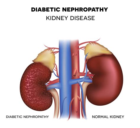 Diabetic Nephropathy;Physiotherapy approach, a case …