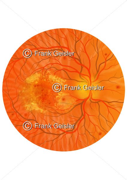 Diabetische Retinopathie bei Patienten mit Diabetes mellitus