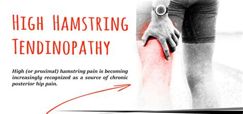 Diagnosing Chronic High (Proximal) Hamstring Tendinopathy