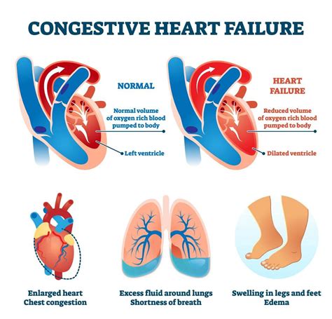 Diagnosing Congestive Heart Failure - HealthyHeartWorld.com