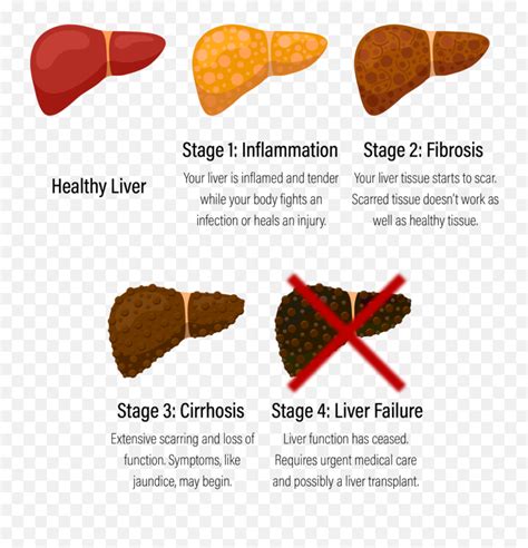 Diagnosing Liver Fibrosis: Choosing the Right Test for …