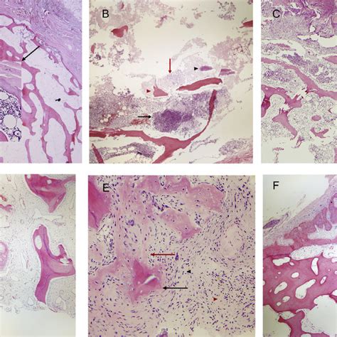 Diagnosing Osteomyelitis: A Histology Guide for Pathologists