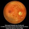 Diagnosis Retinopati Diabetik - Alomedika