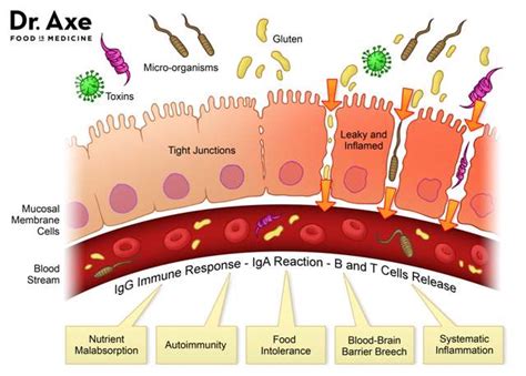 Diagnosis and Treatment of Leaky Gut: Part II