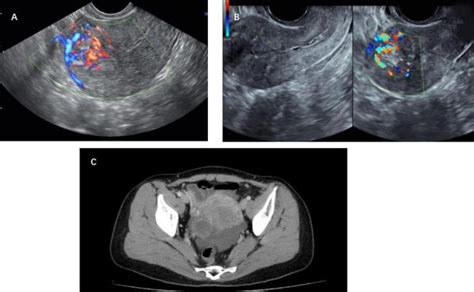 Diagnosis and management of intramural ectopic …