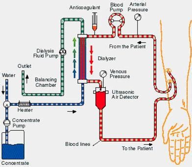 Dialysis Equipment: The Past and The Present - History of Dialysis