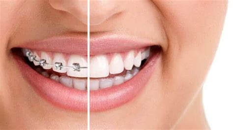 Diamond braces orthodontist braces & invisalign. Things To Know About Diamond braces orthodontist braces & invisalign. 