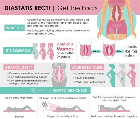 Diastasis Recti – How To Fix Ab Separation During Pregnancy