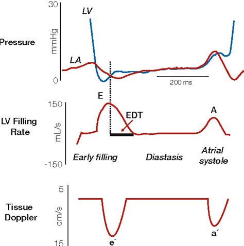 Diastolic Dysfunction: Improved Understanding …