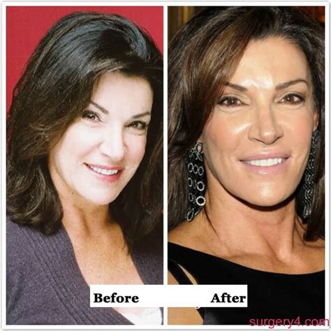 Everything about Hilary Farr Plastic Surgery including her Facelift, Nose job and Botox shots. Pictures before and after surgery included.