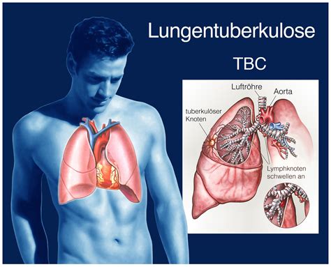 Die intestinale tuberkulose infektion, mit besonderer ber©ơcksichtigung des kindesalters. - Life in the uk test handbook.