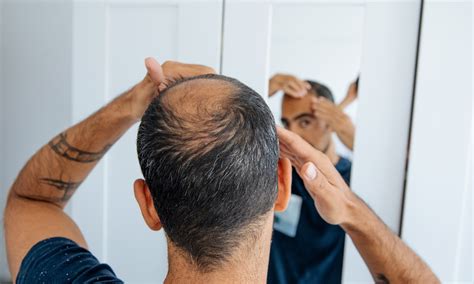 Die ultimative Lösung für männlichen Haarausfall: Hochwertige 