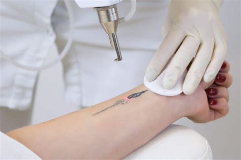 Die ultimative anleitung zum entfernen von tätowierungen the ultimate guide to tattoo removal how to remove tattoo for good. - Prelude peotry analysis sheet answer key.