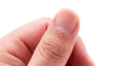 Difference Between Hangnail and Ingrown Nail (2024)