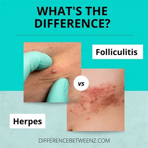 Difference between Folliculitis and Herpes - Difference Betweenz